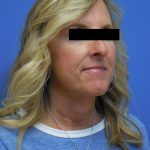 Facelift Before & After Patient #1725