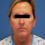 Facelift Before & After Patient #1725