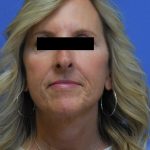 Facelift Before & After Patient #1725