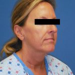 Facelift Before & After Patient #1725