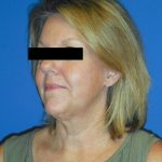 Facelift Before & After Patient #1730