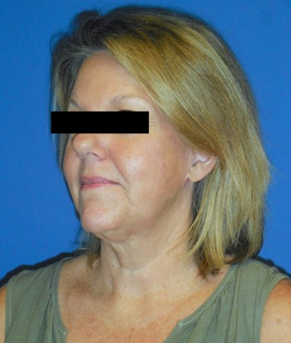 Facelift Before & After Patient #1730
