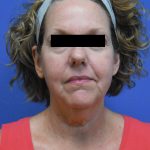Facelift Before & After Patient #1730