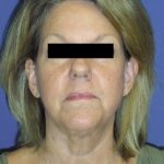 Facelift Before & After Patient #1730