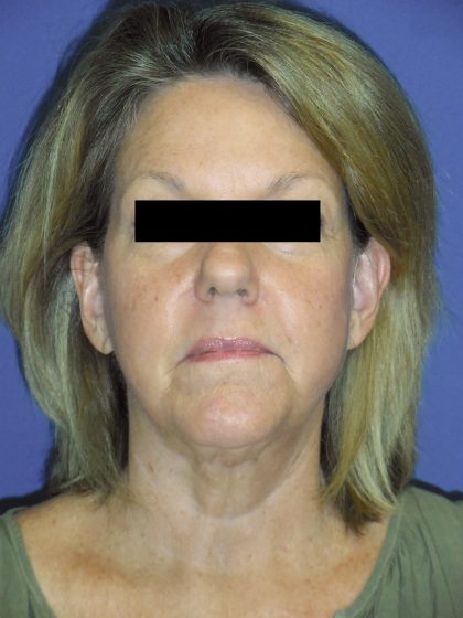 Facelift Before & After Patient #1730