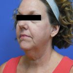 Facelift Before & After Patient #1730