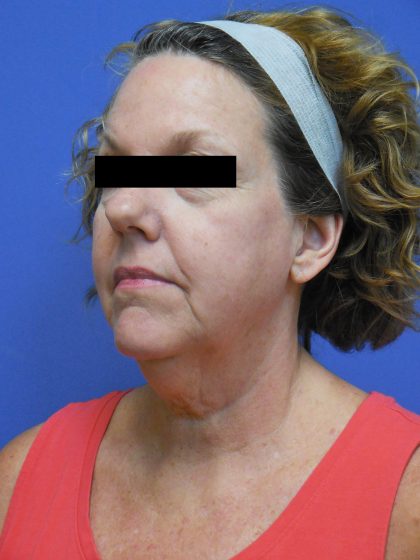 Facelift Before & After Patient #1730