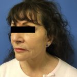 Facelift Before & After Patient #1735