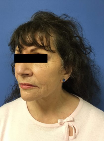 Facelift Before & After Patient #1735