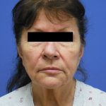 Facelift Before & After Patient #1735