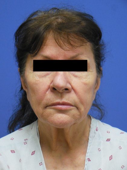 Facelift Before & After Patient #1735