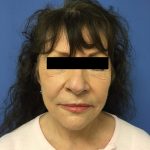 Facelift Before & After Patient #1735