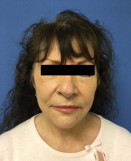 Facelift Before & After Patient #1735