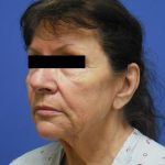Facelift Before & After Patient #1735