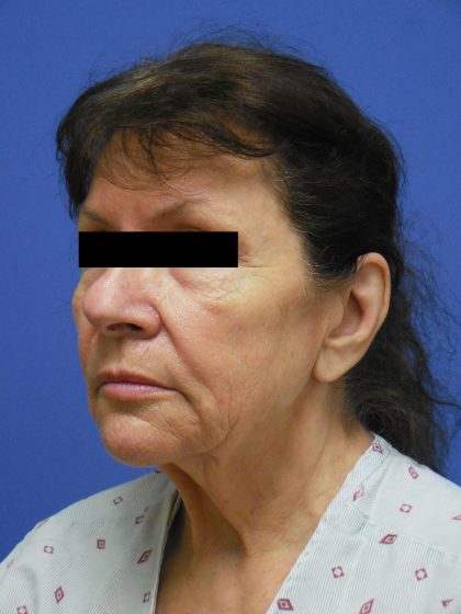 Facelift Before & After Patient #1735