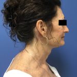 Facelift Before & After Patient #1755
