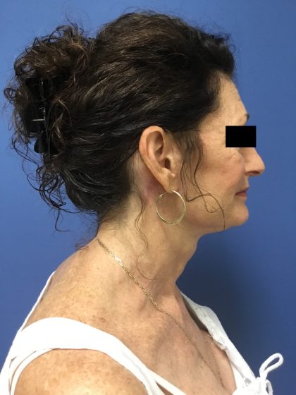 Facelift Before & After Patient #1755