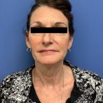 Facelift Before & After Patient #1755