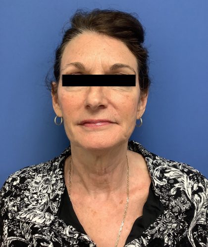 Facelift Before & After Patient #1755