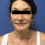 Facelift Before & After Patient #1755