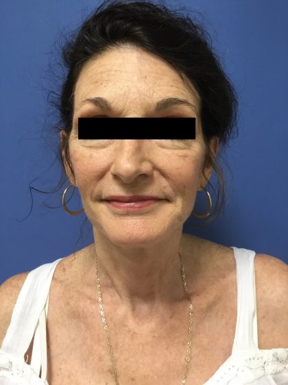 Facelift Before & After Patient #1755