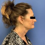 Facelift Before & After Patient #1755