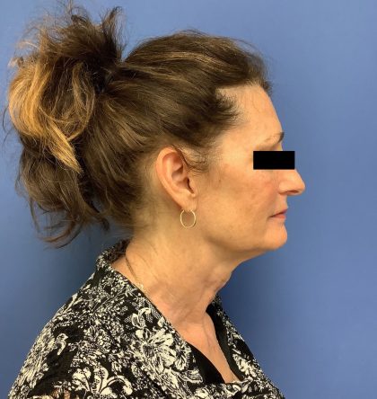 Facelift Before & After Patient #1755