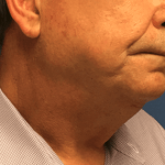Facelift Before & After Patient #1760