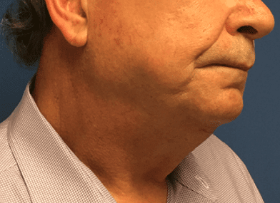 Facelift Before & After Patient #1760