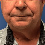 Facelift Before & After Patient #1760