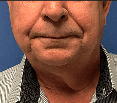 Facelift Before & After Patient #1760