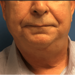 Facelift Before & After Patient #1760