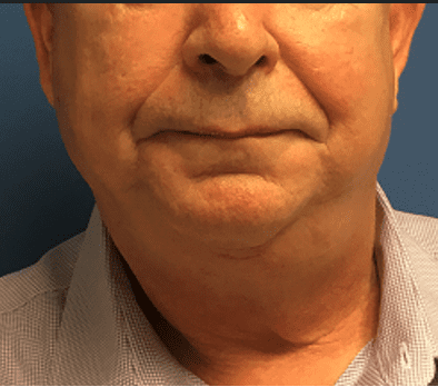 Facelift Before & After Patient #1760
