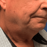 Facelift Before & After Patient #1760
