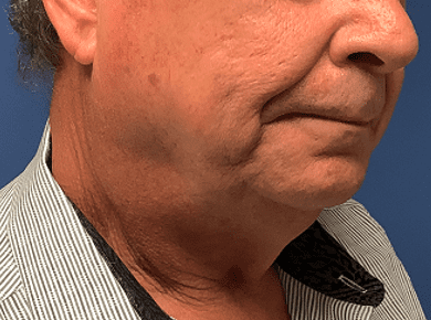 Facelift Before & After Patient #1760