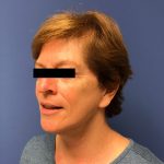 Facelift Before & After Patient #1765
