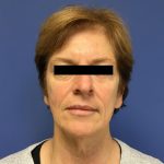 Facelift Before & After Patient #1765
