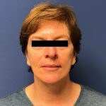 Facelift Before & After Patient #1765