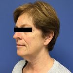 Facelift Before & After Patient #1765