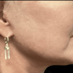 Facelift Before & After Patient #1770