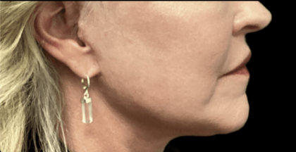 Facelift Before & After Patient #1770