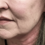 Facelift Before & After Patient #1770