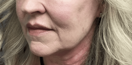 Facelift Before & After Patient #1770