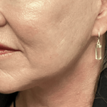 Facelift Before & After Patient #1770