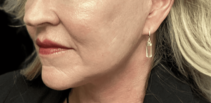 Facelift Before & After Patient #1770