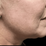 Facelift Before & After Patient #1770
