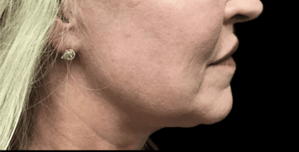 Facelift Before & After Patient #1770