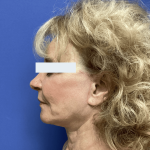 Facelift Before & After Patient #1775