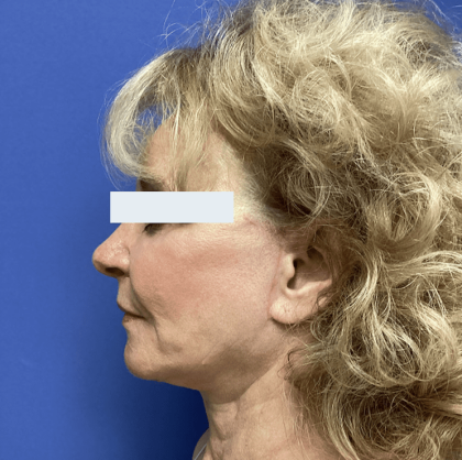 Facelift Before & After Patient #1775