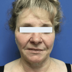 Facelift Before & After Patient #1775